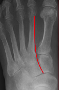 Lisfranc Injuries St Joseph S Health Center Emergency Medicine