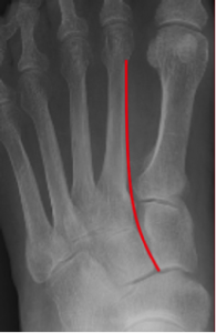 Lisfranc xray1