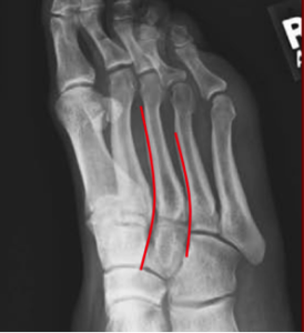 Lisfranc xry2