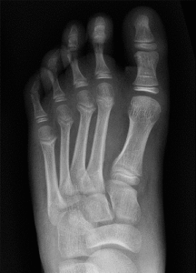 lisfranc 6