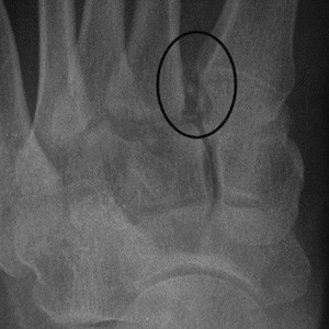 lisfranc xray3