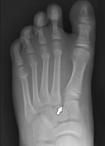 lisfranc6b