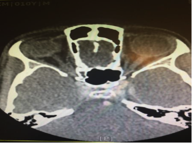 Case of the week COW #11 – St. Joseph's University Medical Center ...
