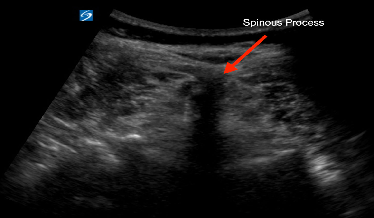 Ultrasound-Guided Lumbar Puncture – St. Joseph's Health Center ...